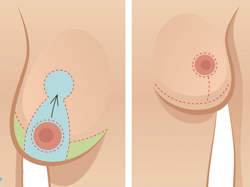 Breast Reduction